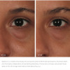 Лифтинговый крем - гель для век ORMEDIC balancing eye lift gel