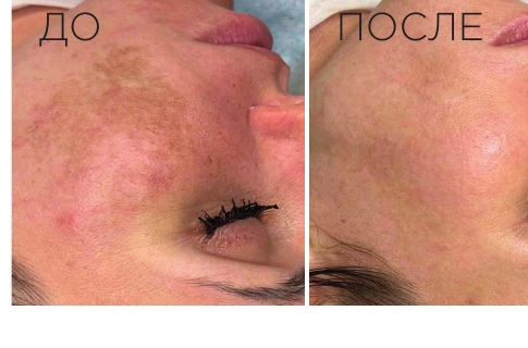 Пигментация и неровный тон: результат до и после IMAGE Skincare