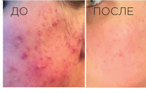 Проблемная кожа: результат до и после IMAGE Skincare