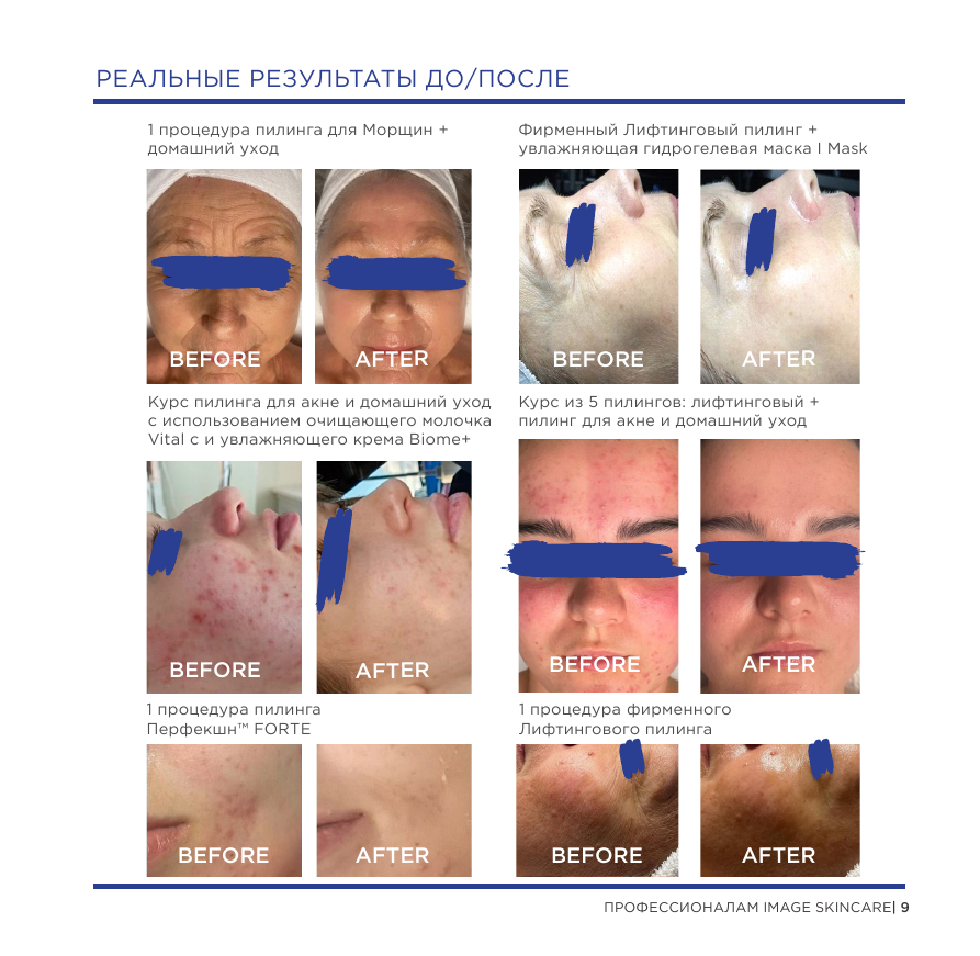 Результаты профессиональных пилингов IMAGE Skincare до и после